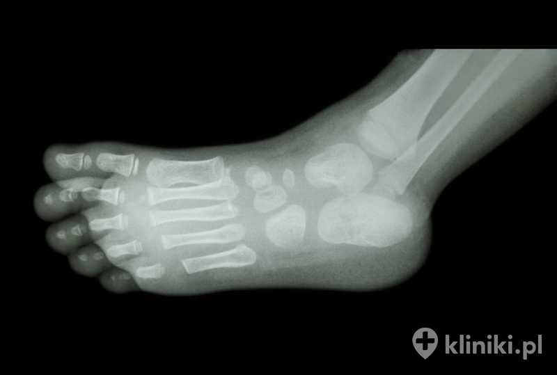 Zabieg stopy końsko–szpotawej pozwala na poprawę funkcji chodu, zmniejszenie bólu oraz zapobieganie dalszym zniekształceniom układu kostno–mięśniowego Zabieg stopy końsko–szpotawej pozwala na poprawę funkcji chodu, zmniejszenie bólu oraz zapobieganie dalszym zniekształceniom układu kostno–mięśniowego
