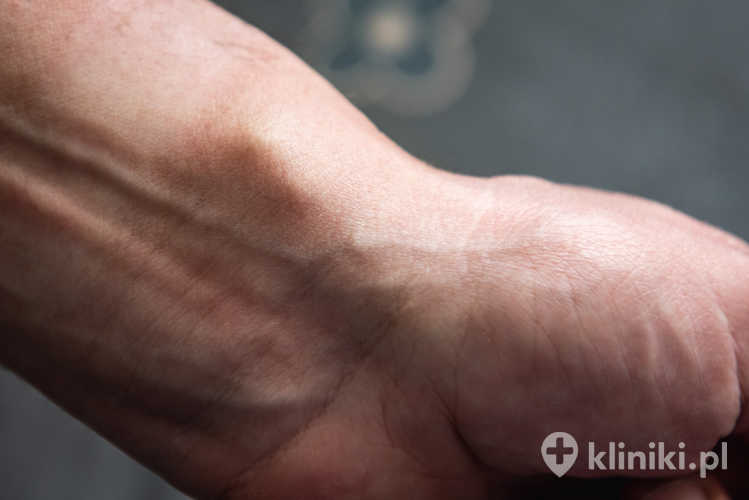 Ganglion nadgarstka objawia się jako miękkie lub twarde zgrubienie, które czasem powoduje ból lub ograniczenie ruchomości