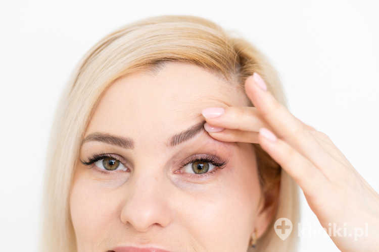 Podniesienie powiek górnych