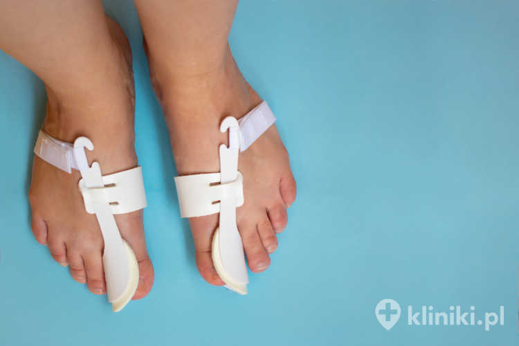 Deformacja palucha często pojawia się u osób z predyspozycjami genetycznymi do osłabienia więzadeł i nieprawidłowej budowy stopy