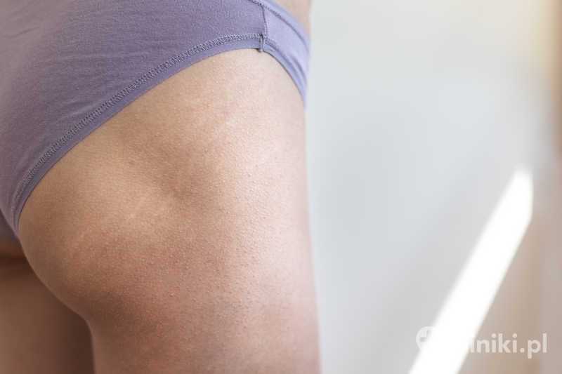 Modelowanie pośladków metodą lipofillingu zapewnia jednoczesne wyszczuplenie okolic, z których pobierany jest materiał Modelowanie pośladków metodą lipofillingu zapewnia jednoczesne wyszczuplenie okolic, z których pobierany jest materiał