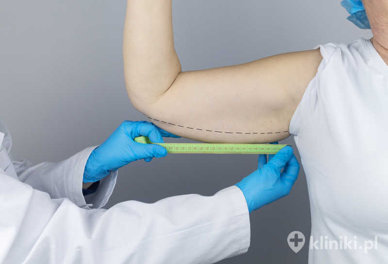 Plastyka ramion pozwala usunąć nadmiar wiotkiej skóry i tkanki tłuszczowej, która często pojawia się po dużej utracie masy ciała lub wraz z wiekiem Plastyka ramion pozwala usunąć nadmiar wiotkiej skóry i tkanki tłuszczowej, która często pojawia się po dużej utracie masy ciała lub wraz z wiekiem