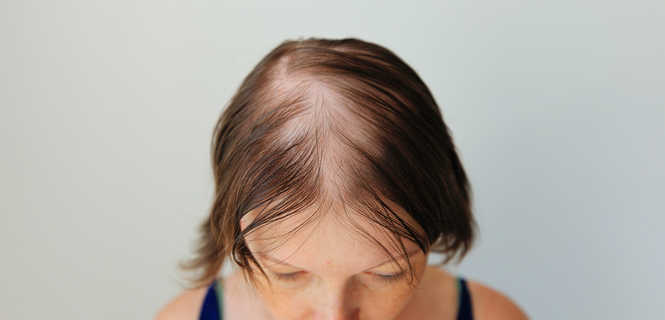 Przeszczep włosów - technika FUT a FUE