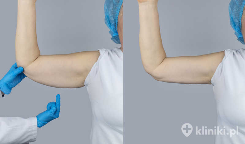 Zabieg modelowania ramion przywraca smukły, bardziej proporcjonalny wygląd kończyn górnych Zabieg modelowania ramion przywraca smukły, bardziej proporcjonalny wygląd kończyn górnych