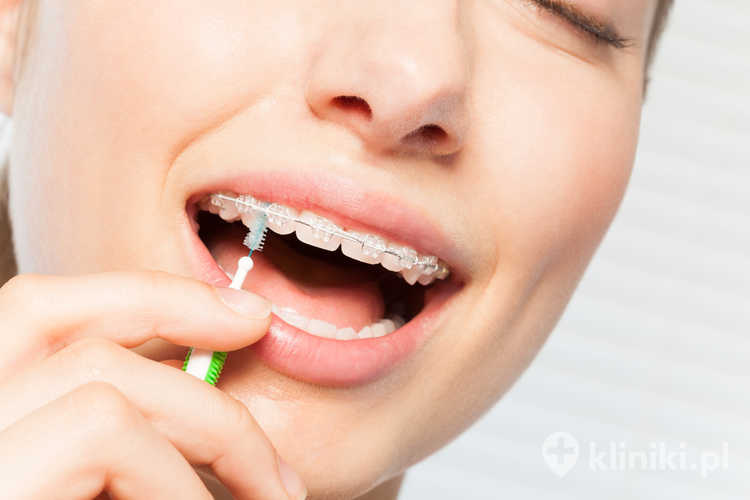 Kobieta czyści aparat za pomocą szczoteczki międzyzębowej