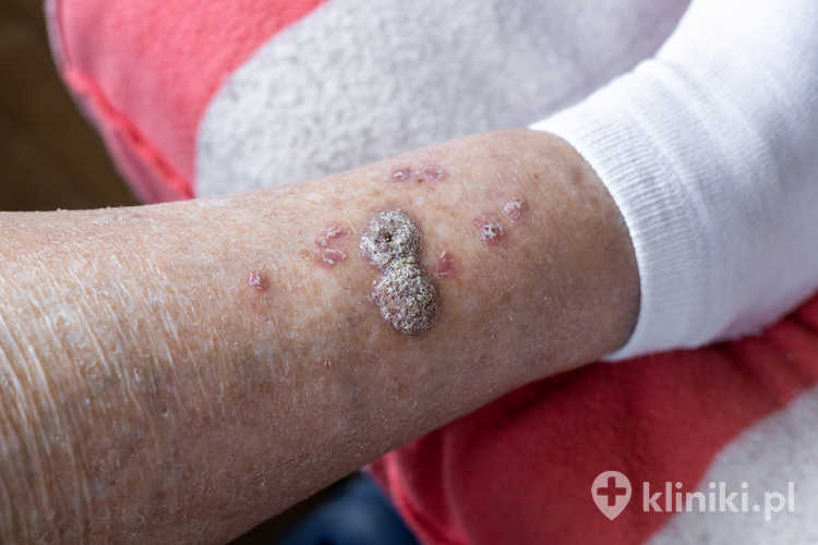 Larwoterapia to metoda leczenia ran polegająca na wykorzystaniu sterylnych larw muchy Lucilia sericata do oczyszczania tkanek z martwicy