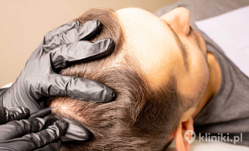 Leczenie łysienia plackowatego najczęściej obejmuje stosowanie miejscowych glikokortykosteroidów lub iniekcji sterydowych bezpośrednio w ogniska chorobowe