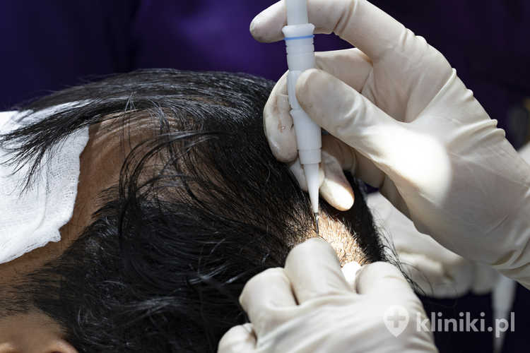 Proces wszczepiania włosów, pobieranie osocza włosów do procesu wszczepiania