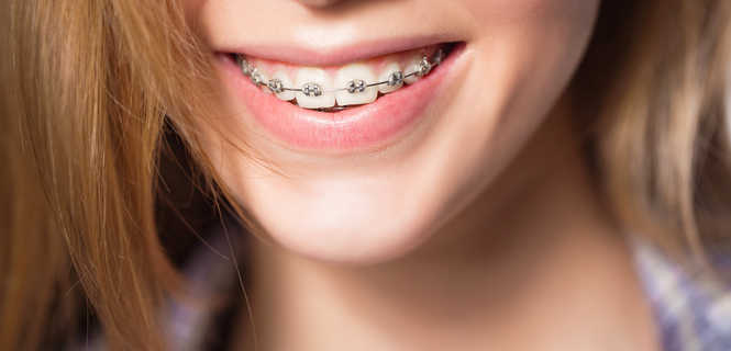 Jak uniknąć przebarwienia ligatur w aparacie ortodontycznym?