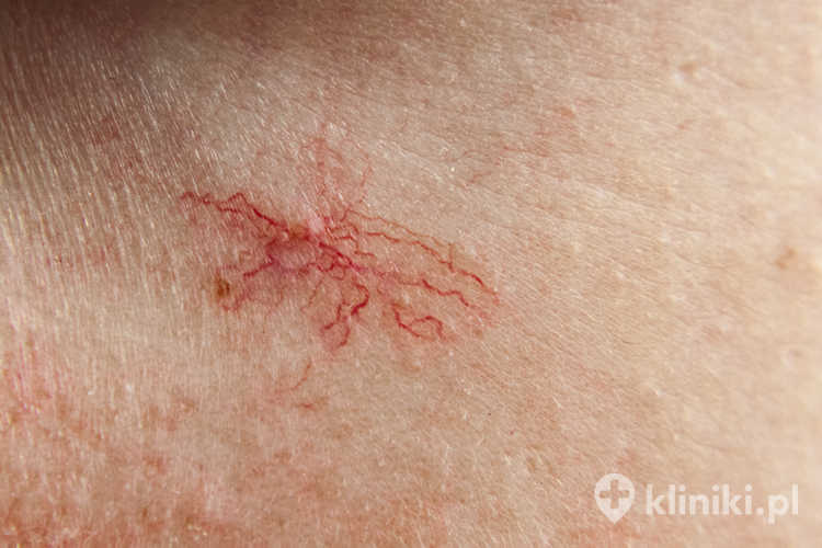 Radiotermoliza zmian skórnych jest bezpieczna, małoinwazyjna i zwykle nie wymaga znieczulenia lub wymaga jedynie miejscowego znieczulenia kremem