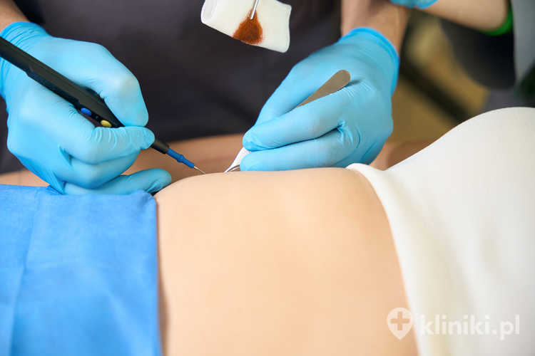 Radiotermoliza zmian skórnych polega na podgrzaniu wybranych obszarów skóry za pomocą prądu o wysokiej częstotliwości, co prowadzi do koagulacji i eliminacji zmiany