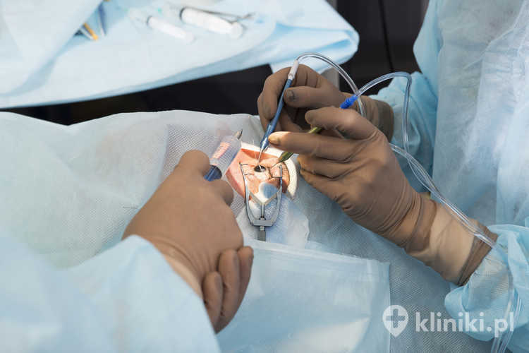 Soczewka asferyczna w leczeniu zaćmy koryguje aberracje sferyczne, co poprawia ostrość i kontrast obrazu, zwłaszcza przy słabym oświetleniu