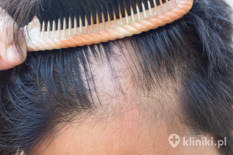 Transplantacja włosów rozpoczyna się od dokładnej konsultacji i zaplanowania linii włosów oraz liczby potrzebnych graftów