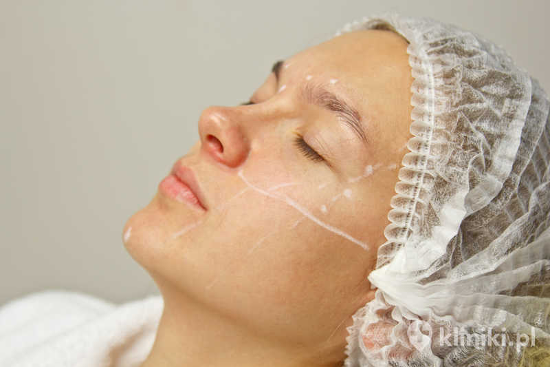 Zabieg modelowania policzków implantami polega na umieszczeniu specjalnych implantów w okolicy jarzmowej, najczęściej przez niewielkie nacięcia wewnątrz jamy ustnej Zabieg modelowania policzków implantami polega na umieszczeniu specjalnych implantów w okolicy jarzmowej, najczęściej przez niewielkie nacięcia wewnątrz jamy ustnej