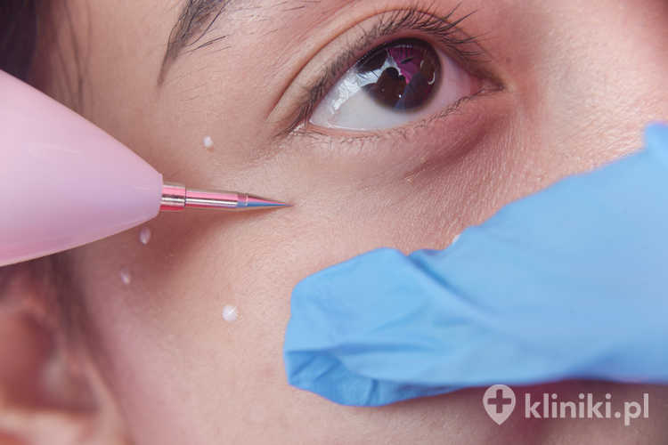 Zabieg radiotermolizy zmian skórnych jest wykorzystywany m.in. do usuwania włókniaków, brodawek, naczyniaków oraz drobnych znamion