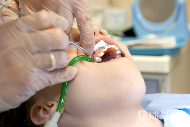 Założenie aparatu ortodontycznego rozpoczyna się od dokładnego oczyszczenia i osuszenia powierzchni zębów