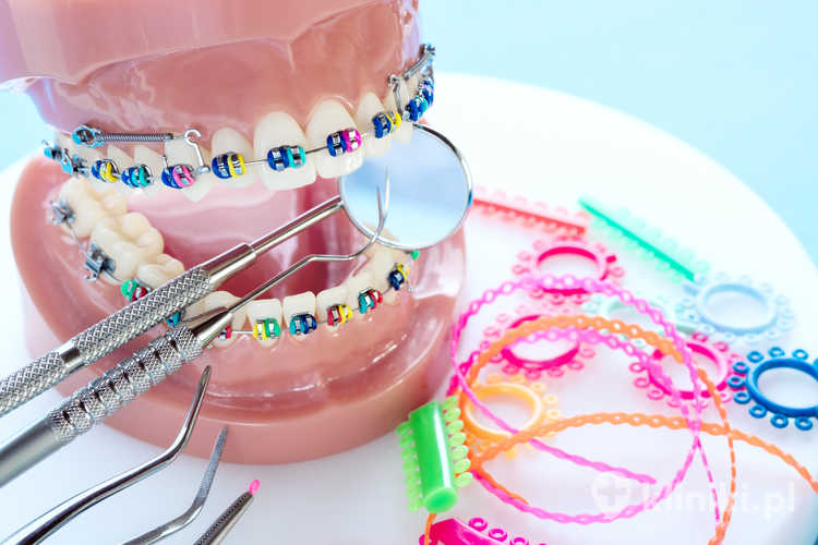 Zmiana koloru ligatur w aparacie ortodontycznym może być także skutkiem palenia papierosów lub używania e-papierosów