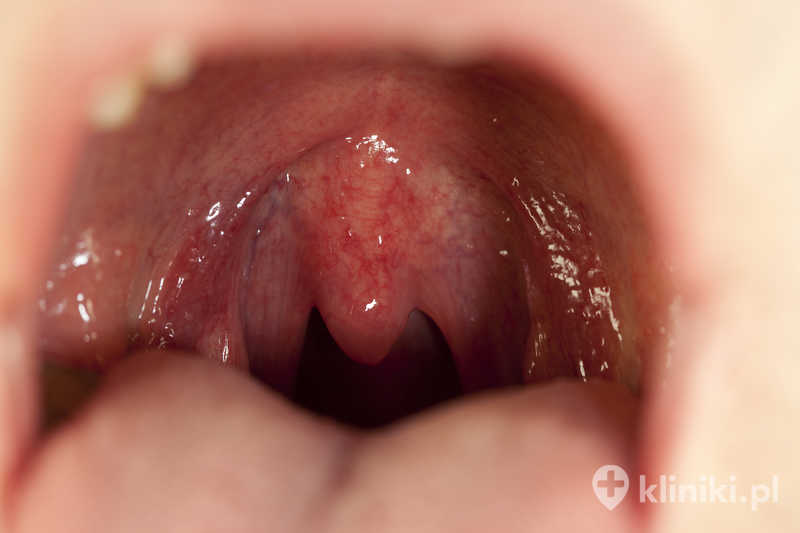 Zmniejszenie migdałków podniebiennych pozwala ograniczyć częstotliwość infekcji gardła, nosa i uszu Zmniejszenie migdałków podniebiennych pozwala ograniczyć częstotliwość infekcji gardła, nosa i uszu