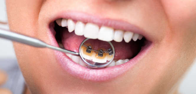 Aparaty ortodontyczne Incognito