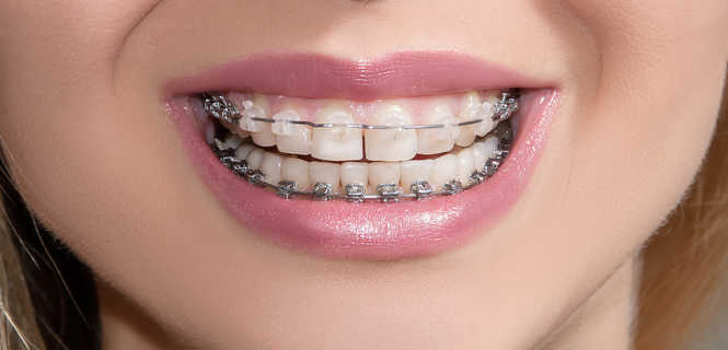 Czy założenie aparatu ortodontycznego boli?