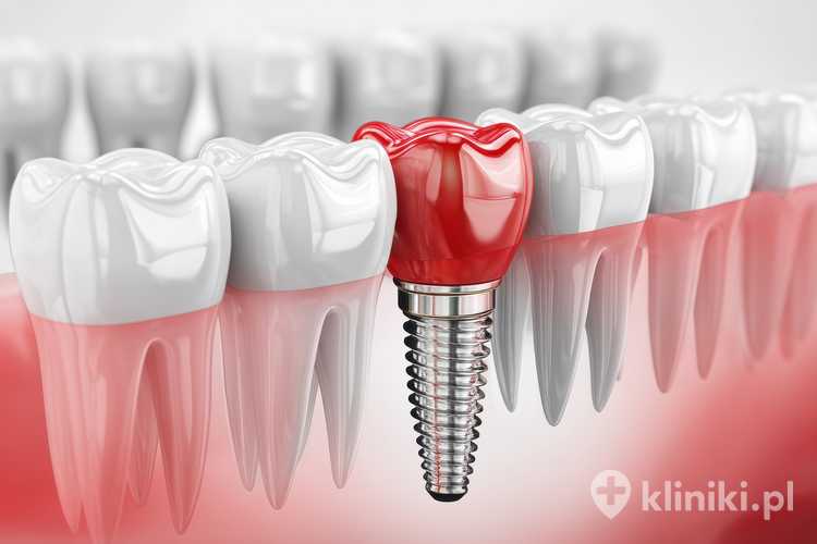 Implanty zębowe