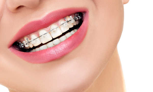 Jak działa aparat ortodontyczny?