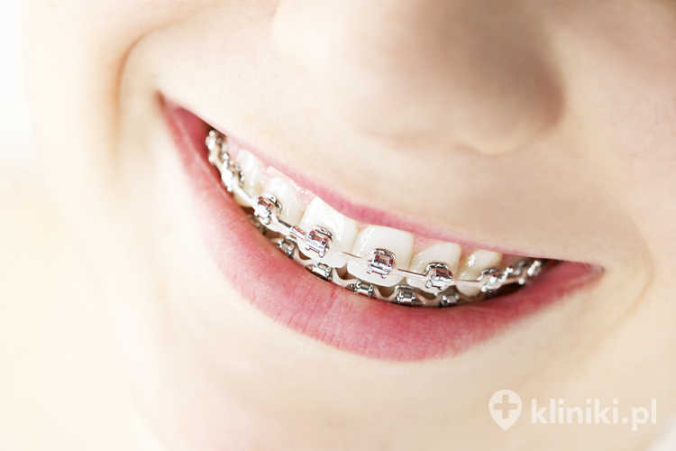 Jak wybrać odpowiedni rodzaj zamków?