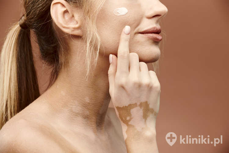 Leczenie bielactwa laserem Excimer jest bezbolesne, a efekty w postaci repigmentacji skóry mogą być widoczne już po kilku tygodniach terapii