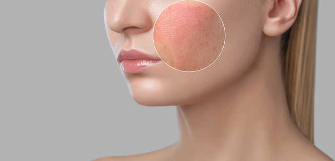 Leczenie chorób skóry