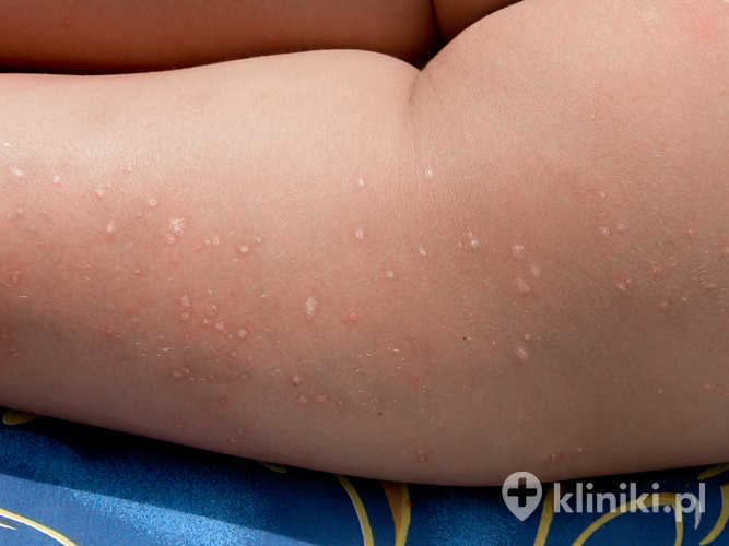 Leczenie chorób skóry powinno zawsze uwzględniać edukację pacjenta, profilaktykę, właściwą pielęgnację oraz identyfikację czynników wyzwalających, co pozwala ograniczać nawroty i poprawiać komfort życia