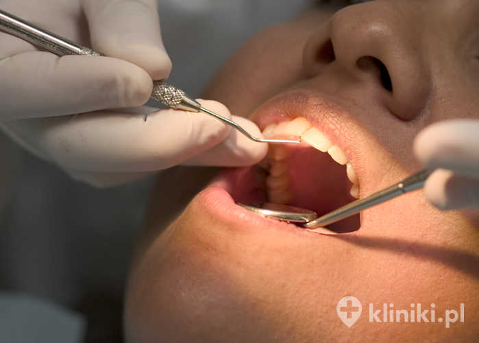 Leczenie endodontyczne