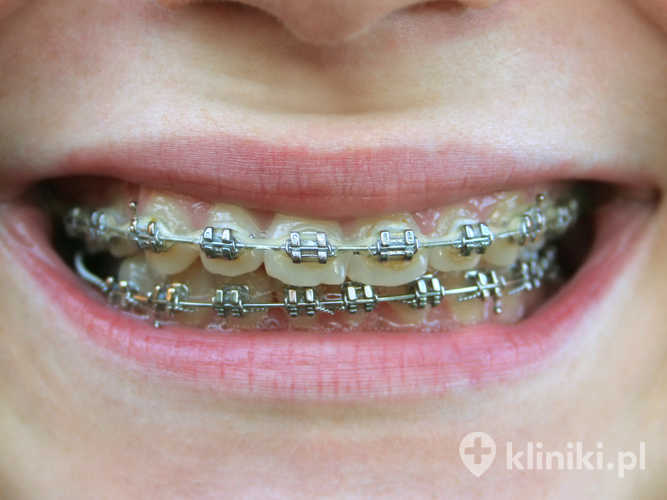 Leczenie stomatologiczne podczas noszenia aparatu