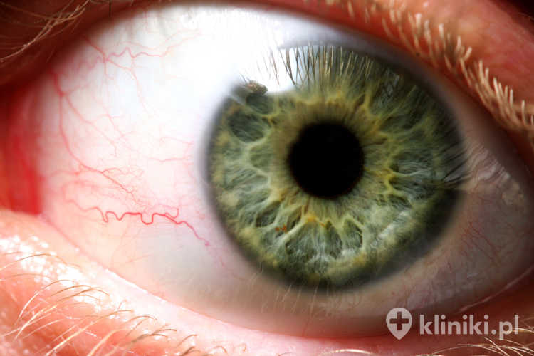 Nowoczesne techniki operacyjne w usuwaniu zaćmy