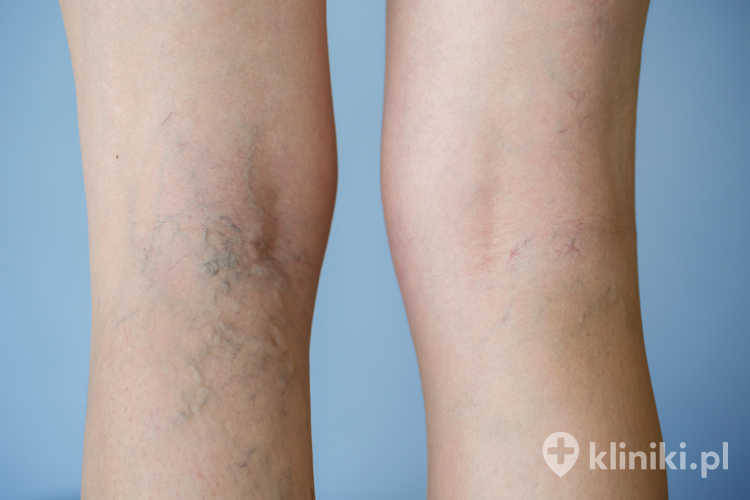 Objawy pajączków naczyniowych