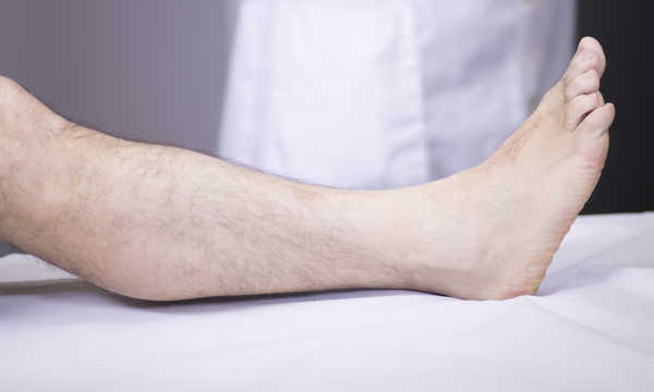 Operacja palca młoteczkowatego stopy to zabieg chirurgiczny mający na celu przywrócenie prawidłowego ustawienia zdeformowanego palca Operacja palca młoteczkowatego stopy to zabieg chirurgiczny mający na celu przywrócenie prawidłowego ustawienia zdeformowanego palca