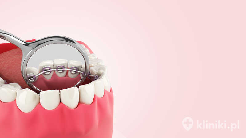 Problemy, które można leczyć aparatami lingwalnymi