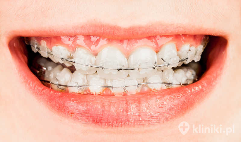 Stałe aparaty ortodontyczne
