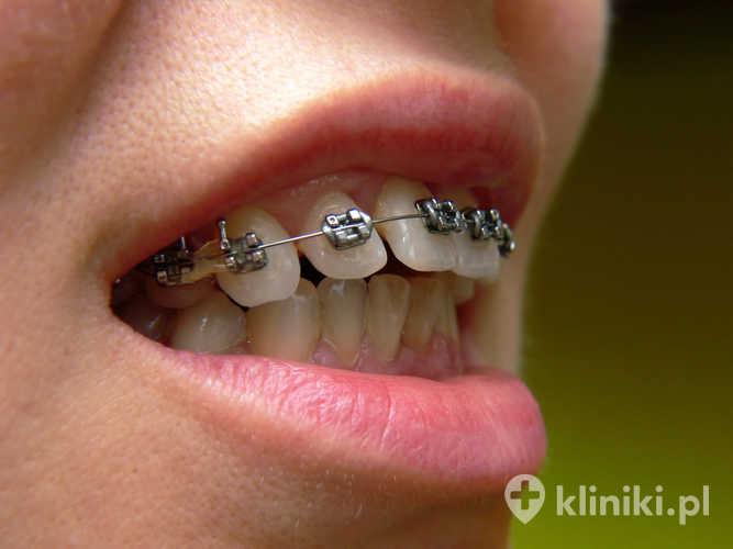 stały aparat ortodontyczny