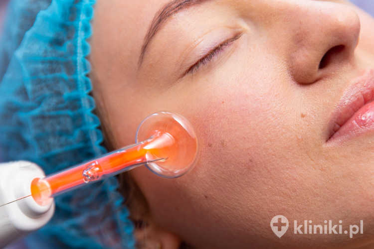 Terapia prądami D’arsonvala to zabieg wykorzystujący wysokoczęstotliwościowy prąd, który poprawia mikrokrążenie i pobudza procesy regeneracyjne skóry