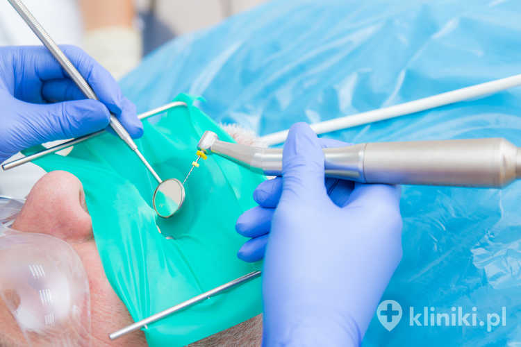 Wskazania do leczenia kanałowego