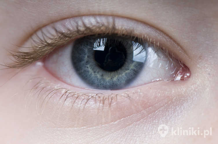 Wskazania do stosowania soczewek asferycznych