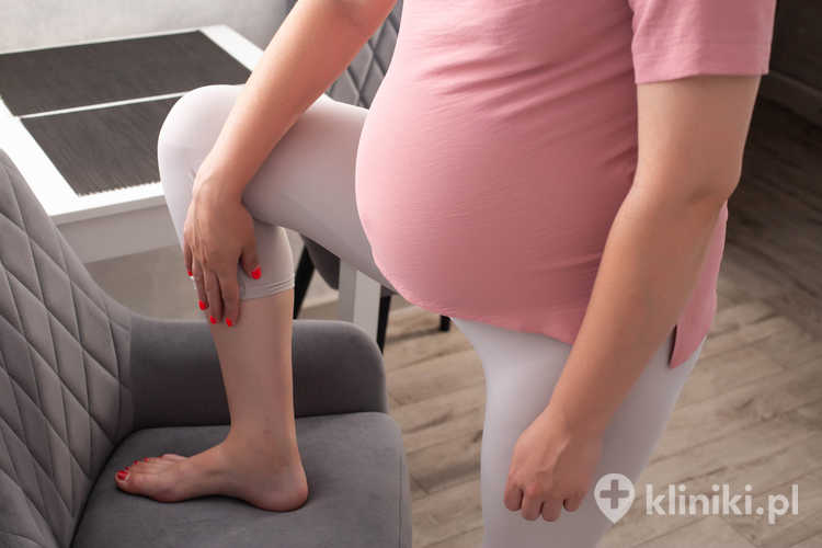 Żylaki w ciąży i po okresie ciąży pojawiają się często z powodu zwiększonego obciążenia układu żylnego oraz działania hormonów rozluźniających ściany naczyń