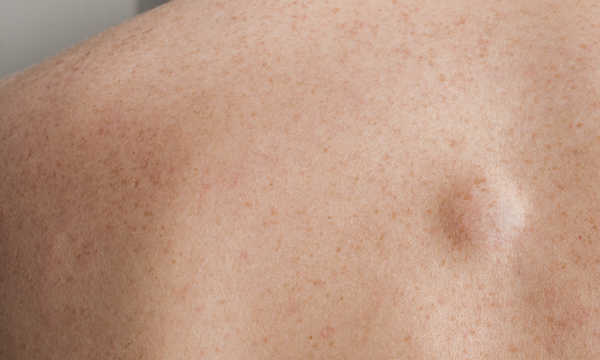 Czy tłuszczaki należy usuwać?