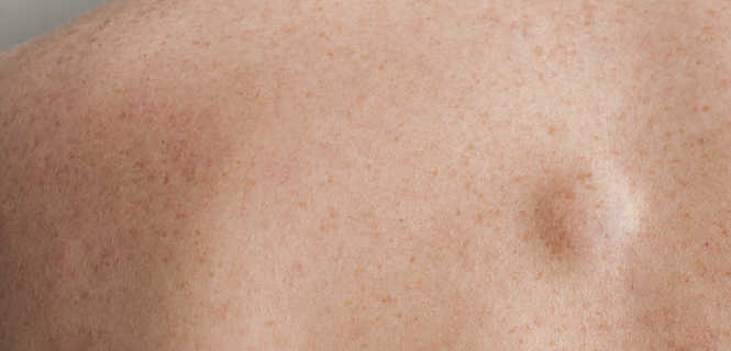 Czy tłuszczaki należy usuwać?