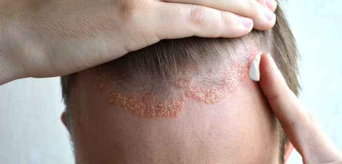 Leczenie łuszczycy surowicą kondycjonowaną ACS