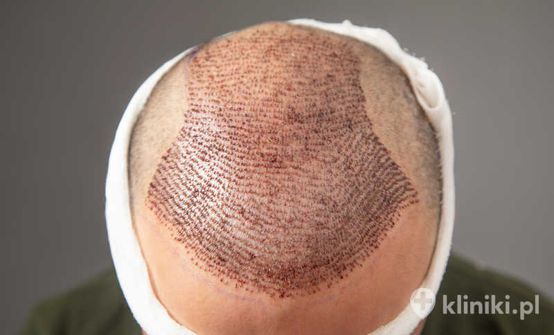 Mężczyzna po transplantacji włosów