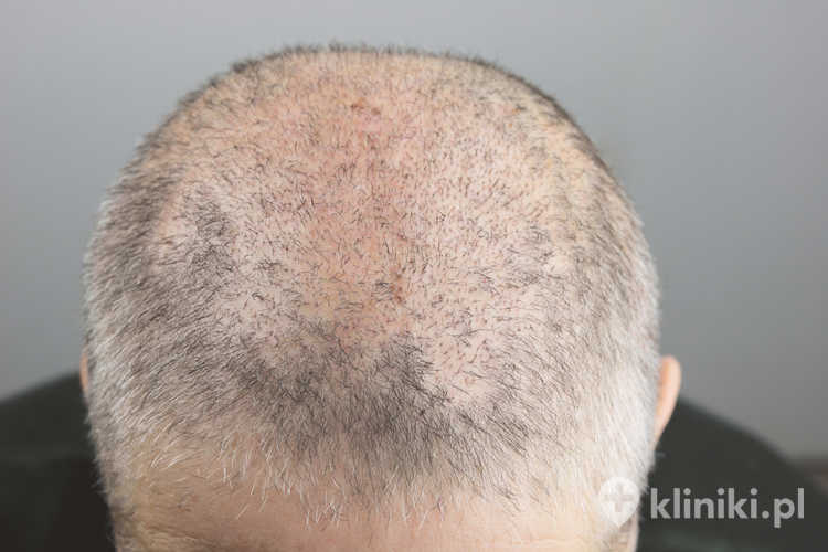 Miejsce implantacji włosów na głowie; mężczyzny dwa tygodnie po przeszczepie