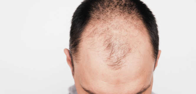 NeoGraft - nowoczesna metoda przeszczepu włosów