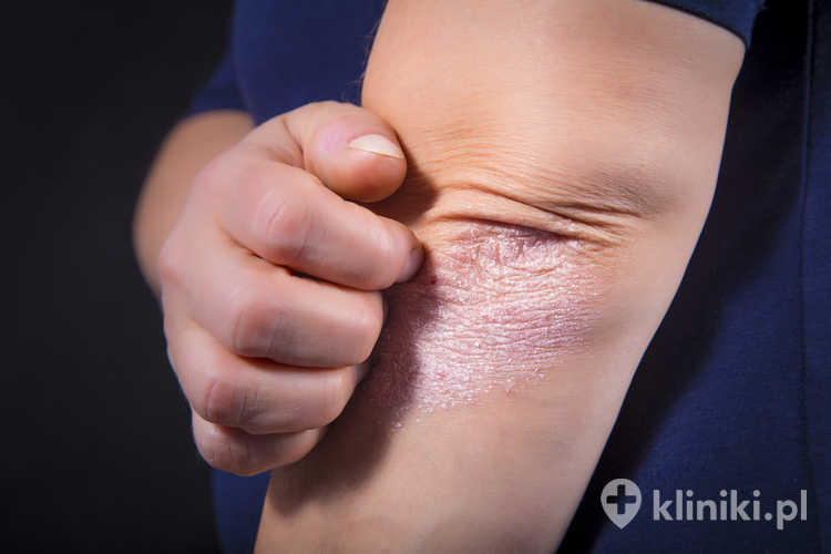 Objawy i charakterystyka łuszczycy