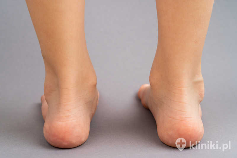 Operacja stopy płasko-koślawej pomaga zmniejszyć ból, poprawić stabilność chodu i zapobiec dalszym zmianom przeciążeniowym